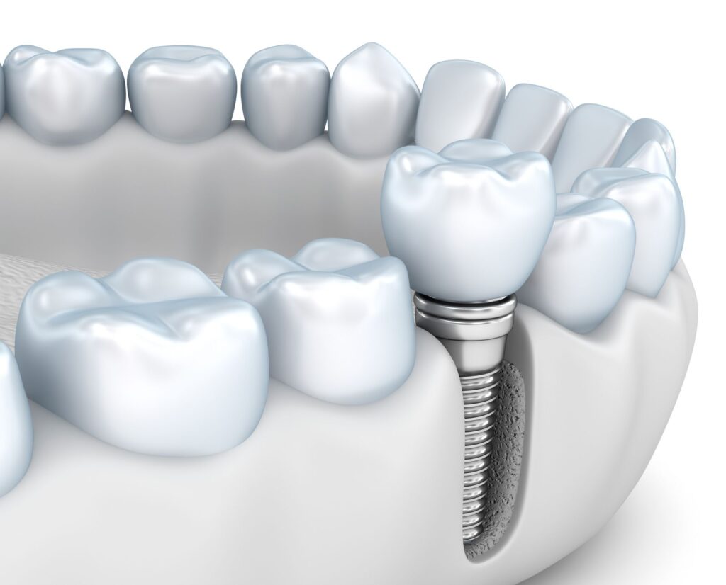 Dental Implants in Reno, NV
