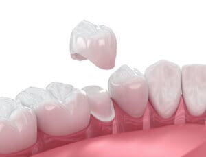 Can a Dental Crown Save Your Tooth? in Reno, NV