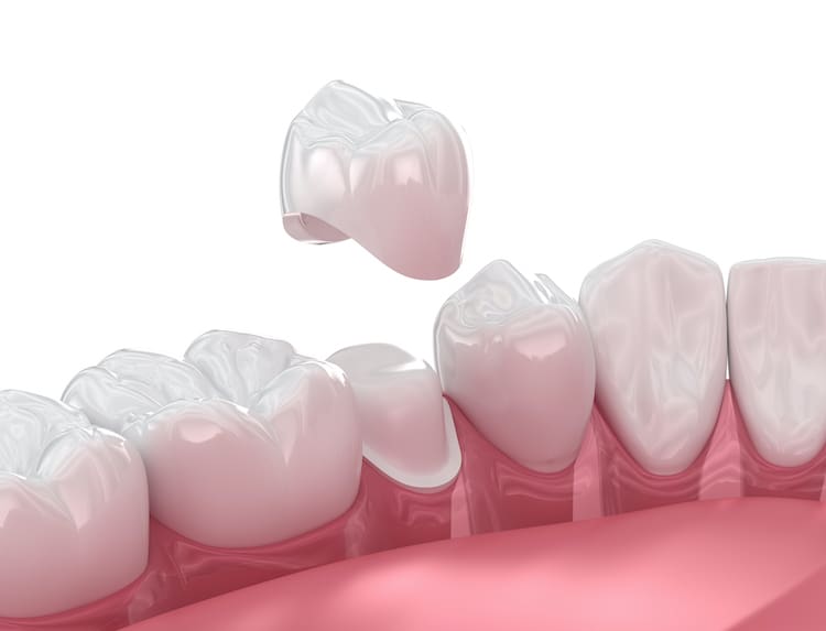 With the right maintenance, your dental crown could last for many years and continue to provide comfort and support.