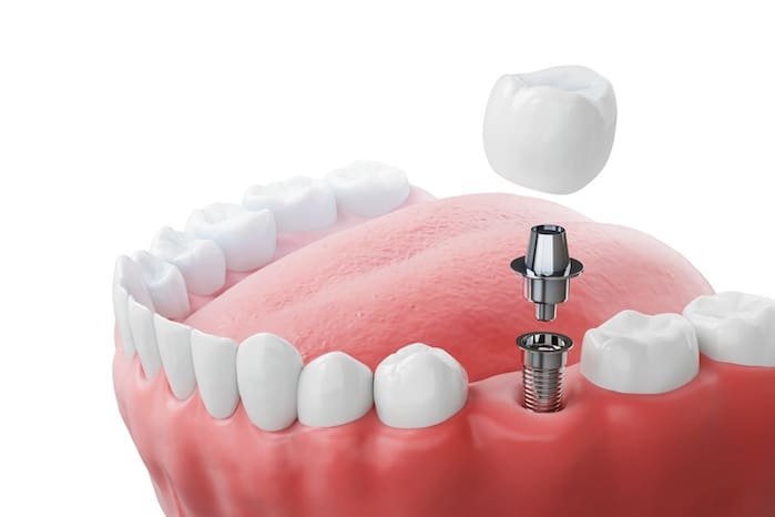 benefits of dental implants in reno, nevada