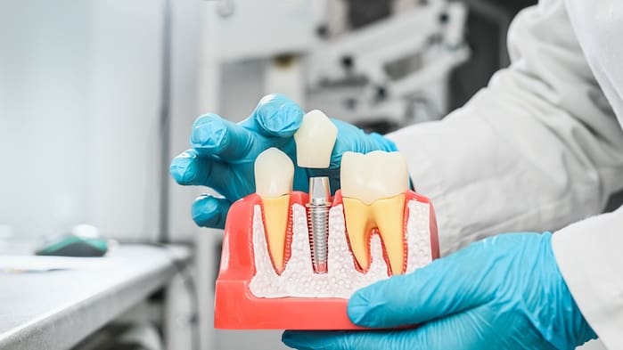 cost of dental implants in reno, nevada