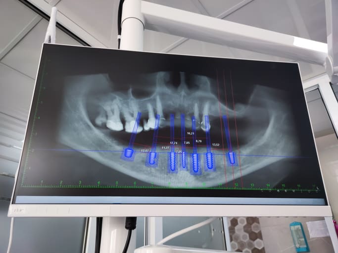 dental implants process in reno, nevada